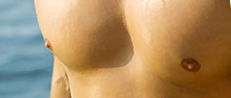 Gynecomastia